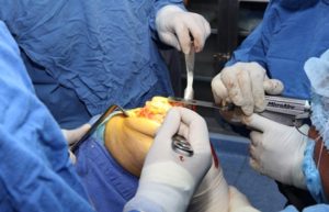 Pacientes hemofílicos