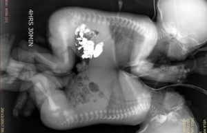 Unidos por tórax y abdomen