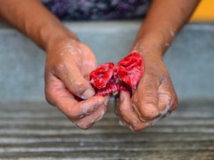 El brote solo se relaciona con la falta de higiene.