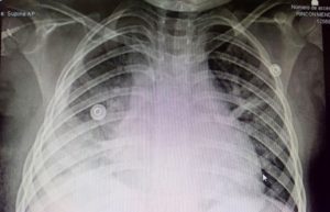 La menor tenía acumulación de líquido en el tórax a consecuencia de una bacteria que le produjo neumonía.
