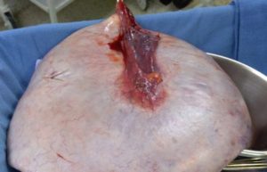 Comprometía la salud de la joven, le provocaba dolor y dificultad para caminar.