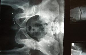 Enfermedad que padecen más las mujeres que los hombres.