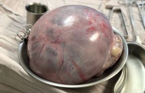 De no haber extirpado el quiste, la paciente seguiría con síntomas opresivos.