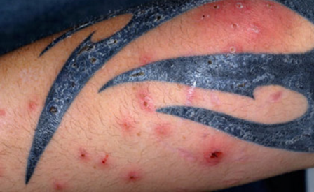 Los tatuajes pueden desencadenar enfermedades cutáneas, advierte médico del IMSS