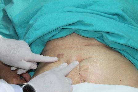 Primer caso en el país de resección de tumor hepático gigante vía laparoscópica: IMSS