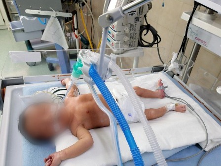 Médicos del IMSS en Ciudad Juárez, atienden exitosamente a dos recién nacidos con órganos expuestos