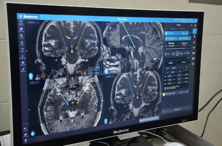 Con estimulación cerebral profunda, pacientes con Parkinson pueden vivir sin síntomas de 15 a 20 años