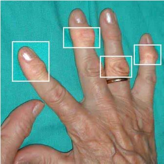 Afecta artritis reumatoide a mujeres jóvenes; tres de cada cuatro enfermos son del sexo femenino