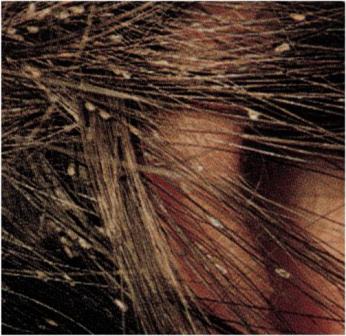 El aseo y uso personalizado de artículos para el cabello protege de pediculosis o piojos