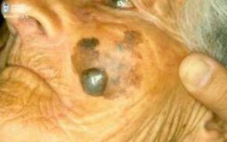 Lesiones y cambios de color en la piel podrían ser indicios de melanomas