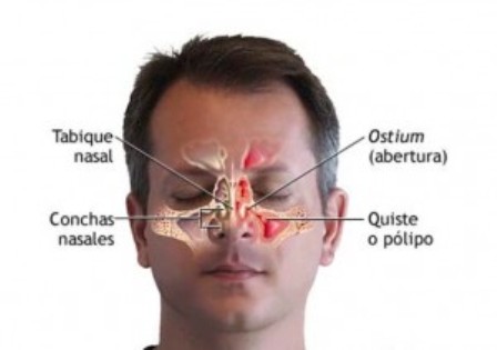 ¿Dificultad para respirar? puede deberse a pólipos nasales: Especialistas del IMSS