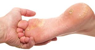 Altos niveles de azúcares en diabéticos puede provocar complicaciones en los pies