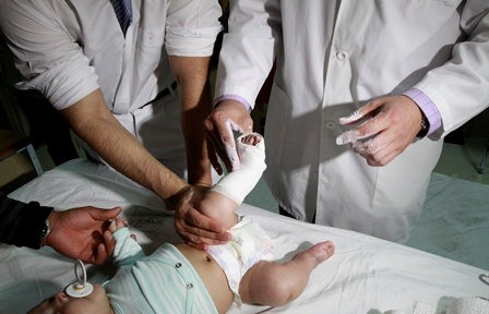 Con técnica de yesos seriados y cirugía de mínima invasión, atiende IMSS a bebés con pie zambo