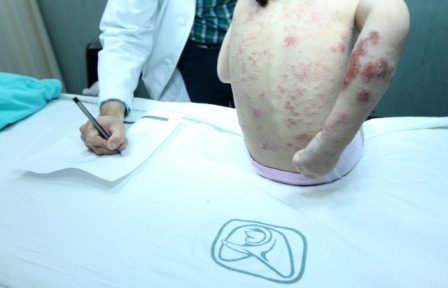 La urticaria en niños, por infecciones o alergias