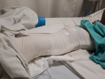 Salvan médicos del IMSS la pierna de policía herido en emboscada