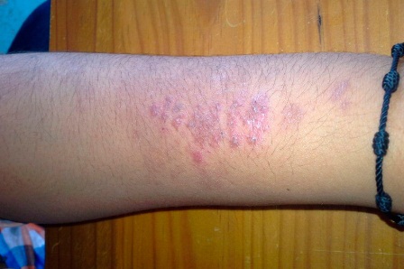Realizan acciones enfocadas para disminuir casos de Leishmaniasis en Oaxaca