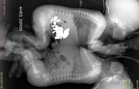 Médicos del IMSS separan con éxito a siameses unidos por tórax y abdomen