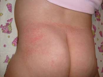 Temporada de calor aumenta en menores de edad dermatitis en el área del pañal