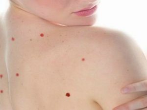 Pueden deberse a desórdenes hepáticos