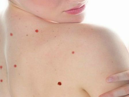 Lunares rojos pueden deberse a desórdenes hepáticos: IMSS