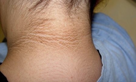 Régimen de ejercicio físico y dieta adecuada, mejor remedio contra la acantosis pigmentaria