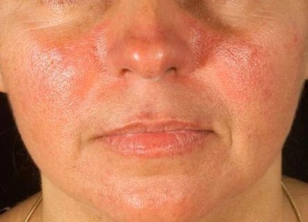 Con antiinflamatorios y esteroides, IMSS brinda tratamiento para controlar el lupus