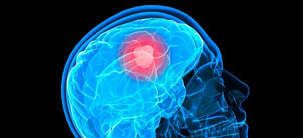 HORMONAS SEXUALES PODRÍAN ESTIMULAR CRECIMIENTO DE TUMORES CEREBRALES