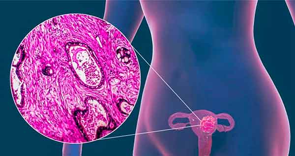 AUMENTA EL NÚMERO DE CASOS DE MUJERES JÓVENES CON CÁNCER CERVICOUTERINO