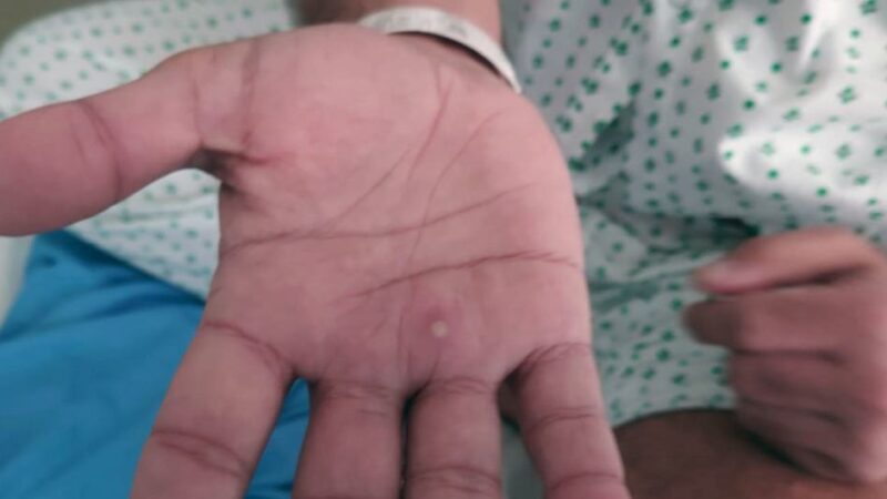 La OPS apoyará el acceso equitativo a la vacuna contra la viruela del mono en América