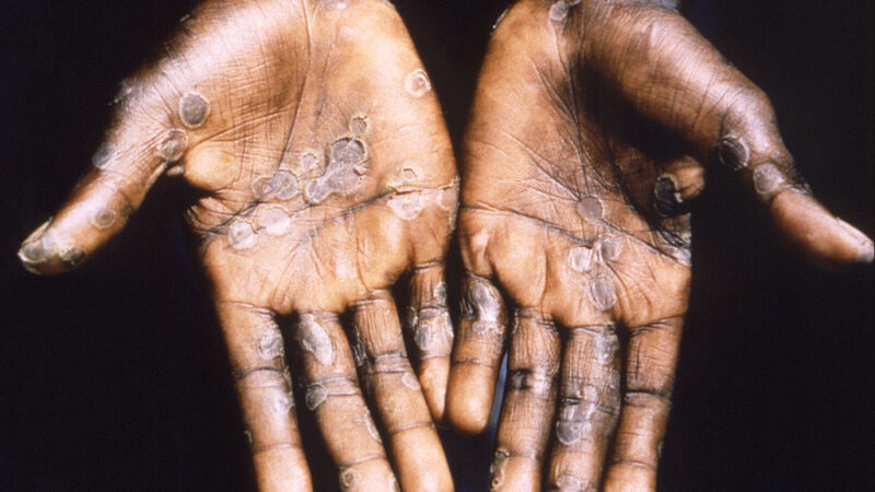 La Organización Mundial de la Salud declara el fin de la emergencia por la viruela del mono