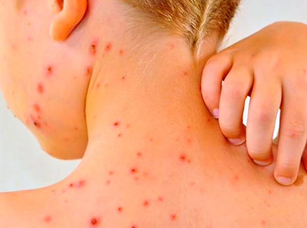 Sarampión, enfermedad reemergente y muy contagioso