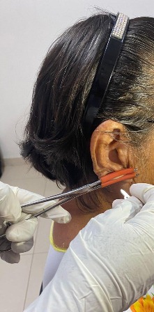 Sin registrarse casos nuevos de lepra en Oaxaca